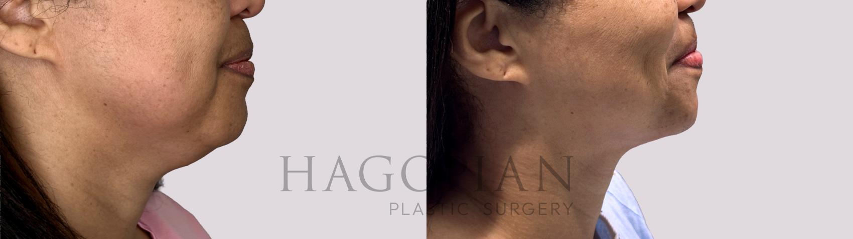 Before & After Chin Liposuction Case 84 Right Side View in Atlanta, GA