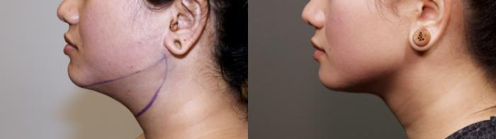 Before & After Chin Liposuction Case 91 Left Side View in Atlanta, GA