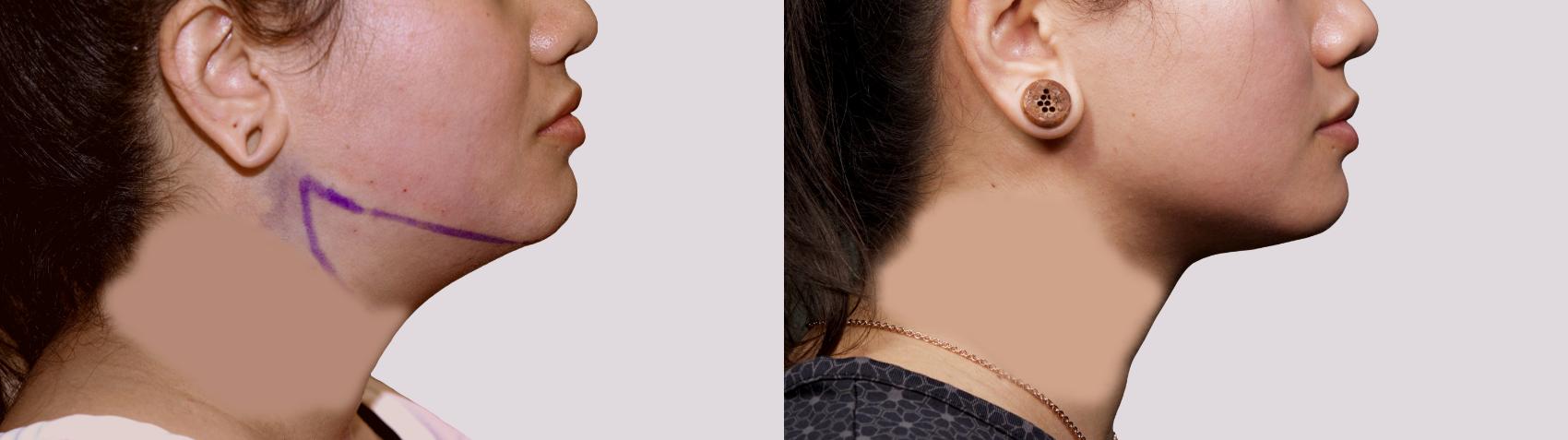 Before & After Chin Liposuction Case 91 Right Side View in Atlanta, GA