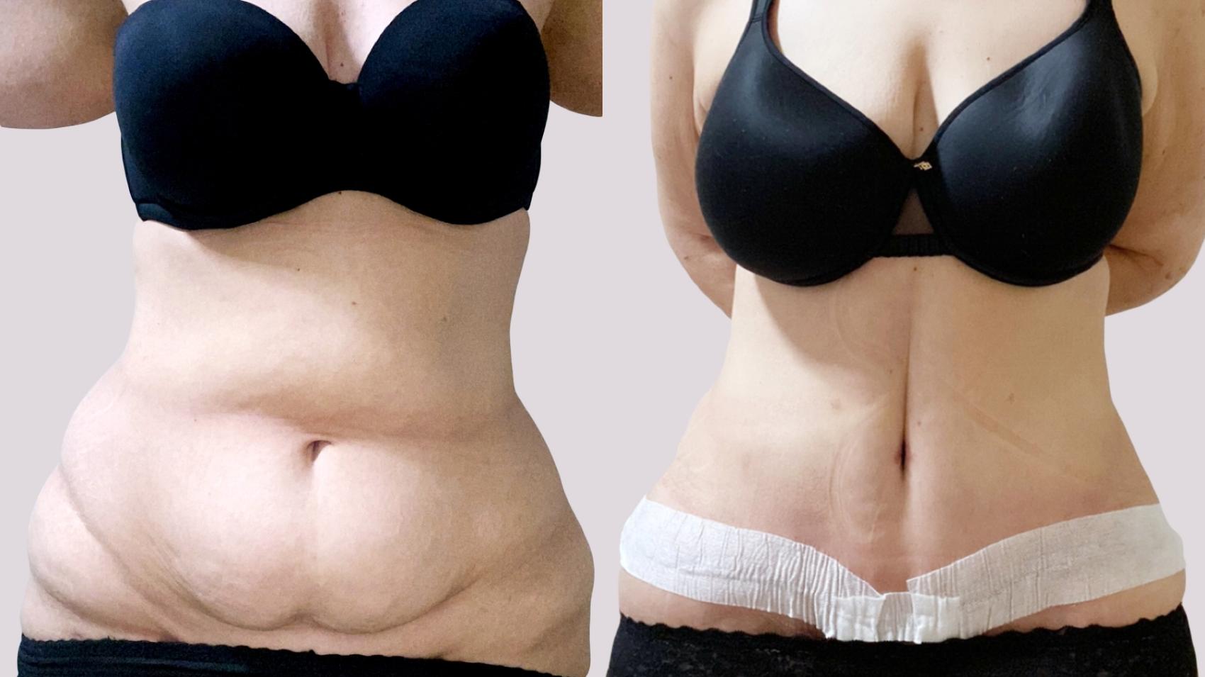 Before & After Drainless Tummy Tuck Case 100 close View in Atlanta, GA