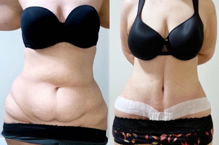 Before & After Drainless Tummy Tuck Case 100 close View in Atlanta, GA