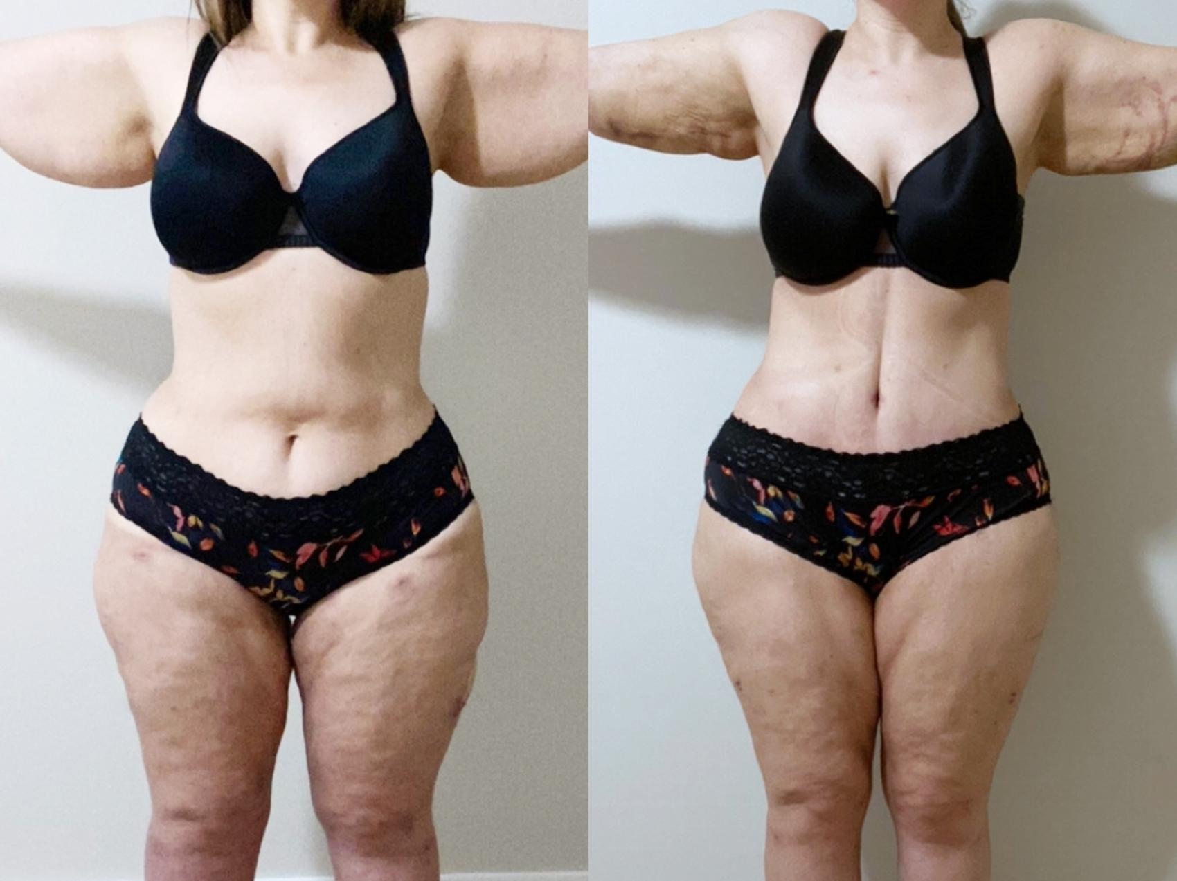 Our patient is THREE MONTHS post Plus Size Tummy Tuck ®! She is lookin