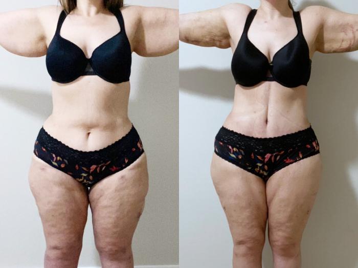 Before & After Drainless Tummy Tuck Case 100 Front View in Atlanta, GA