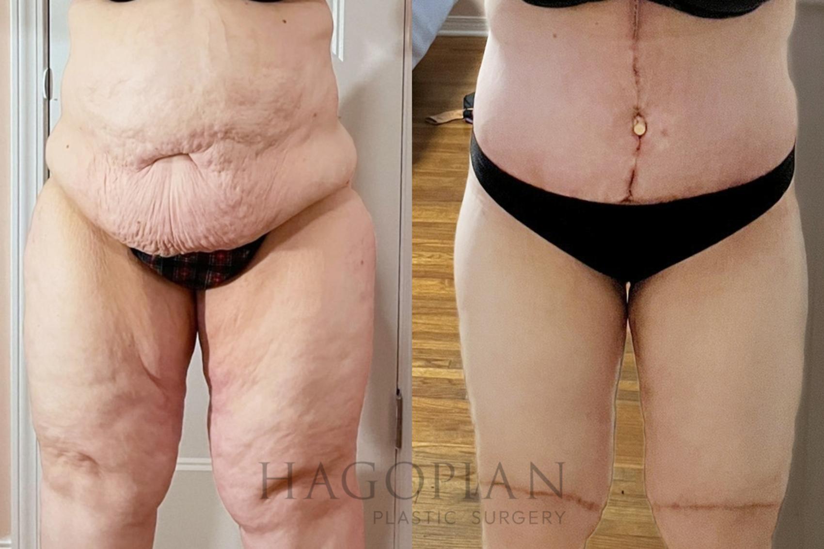 Before & After Drainless Tummy Tuck Case 106 Front View in Atlanta, GA