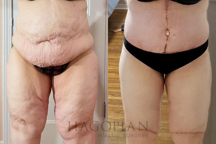 Before & After Arm & Thigh Lift Case 106 Front View in Atlanta, GA