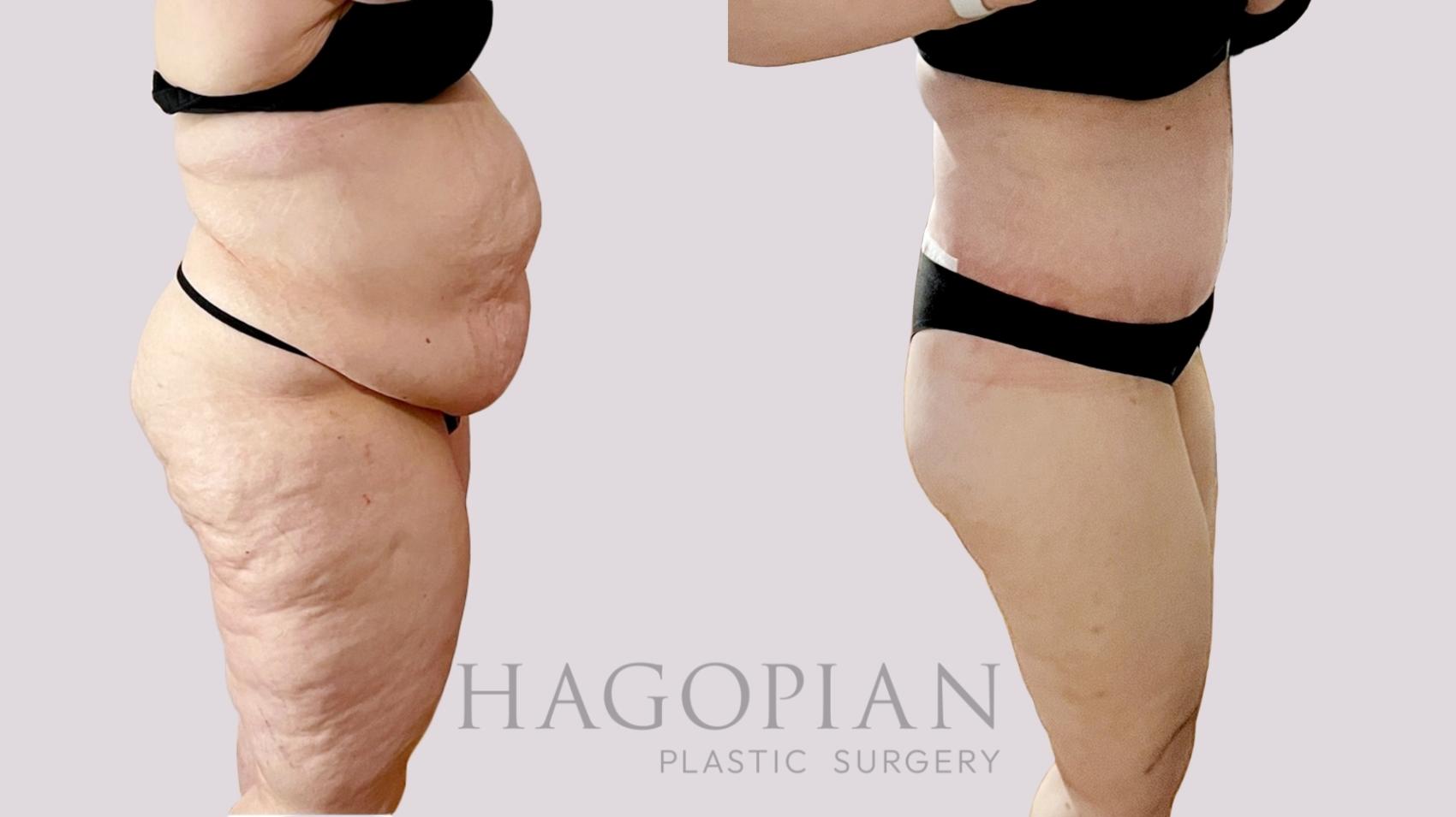 Before & After Drainless Tummy Tuck Case 106 Right Side View in Atlanta, GA