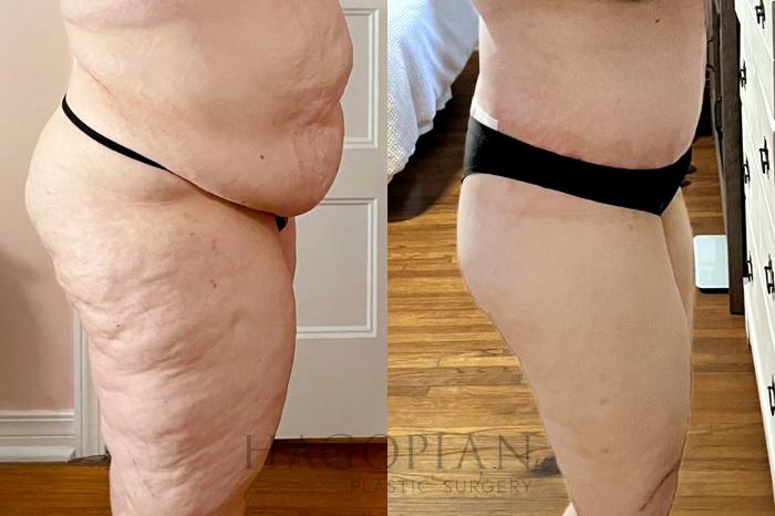 Before & After Drainless Tummy Tuck Case 106 Right Side View in Atlanta, GA
