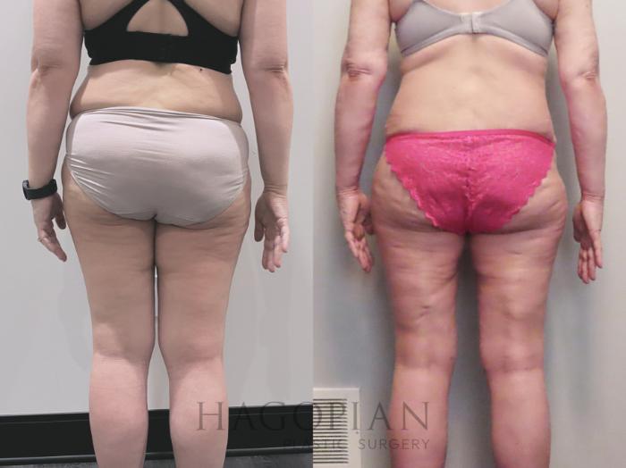 Before & After Drainless Tummy Tuck Case 112 Back View in Atlanta, GA