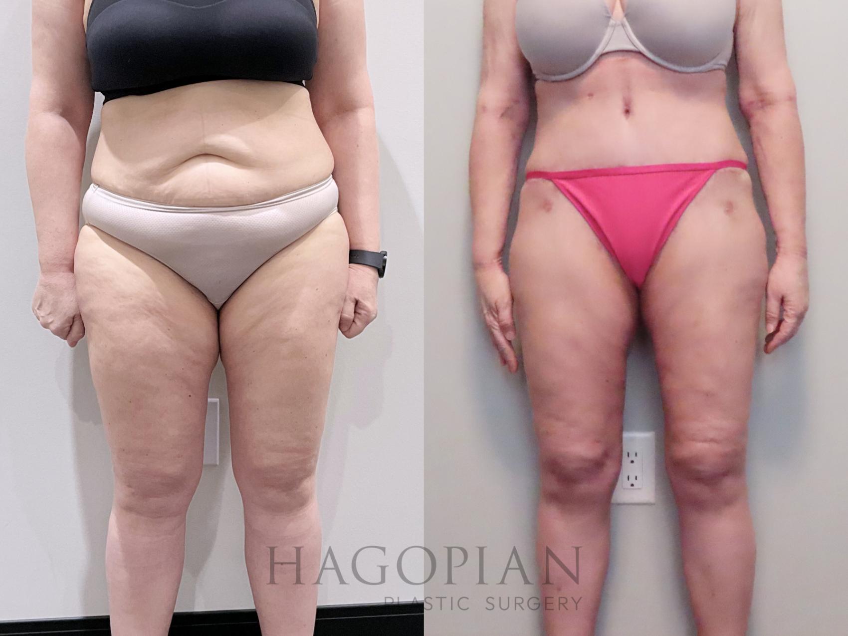 Before & After Drainless Tummy Tuck Case 112 Front View in Atlanta, GA