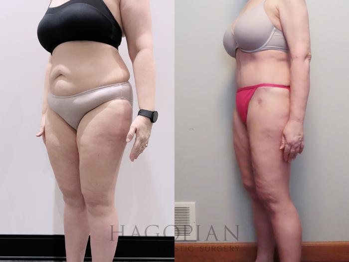 Before & After Drainless Tummy Tuck Case 112 Left Oblique View in Atlanta, GA