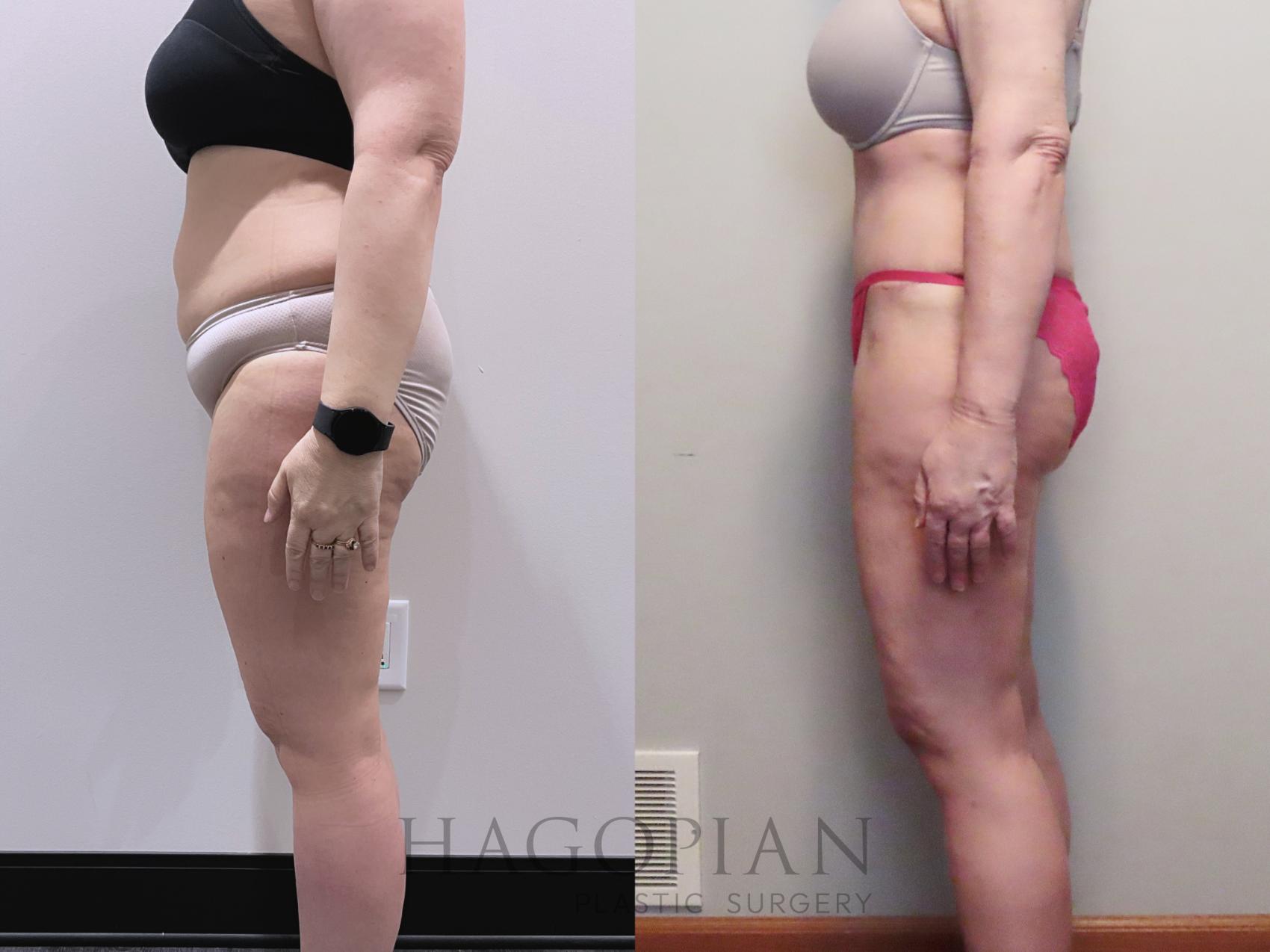 Before & After Drainless Tummy Tuck Case 112 Left Side View in Atlanta, GA