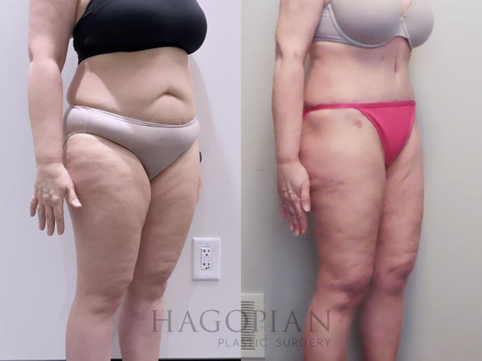 Before & After Drainless Tummy Tuck Case 112 Right Oblique View in Atlanta, GA