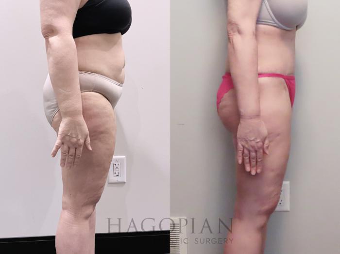 Before & After Drainless Tummy Tuck Case 112 Right Side View in Atlanta, GA