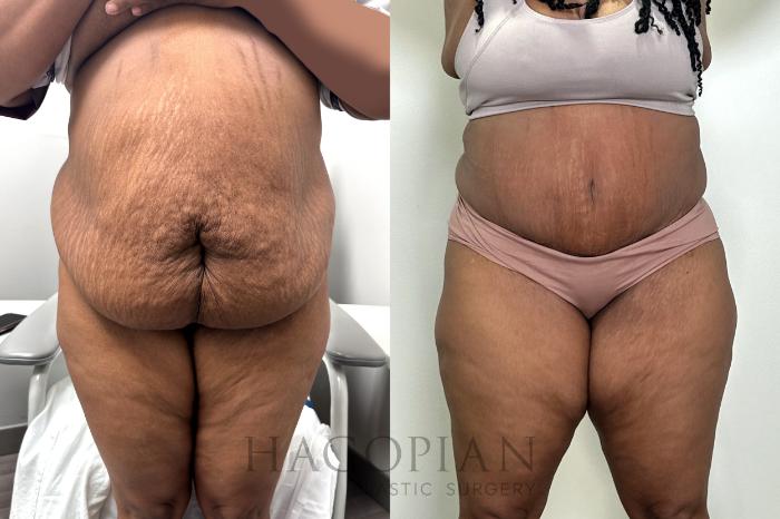 Before & After Drainless Tummy Tuck Case 117 Front View in Atlanta, GA
