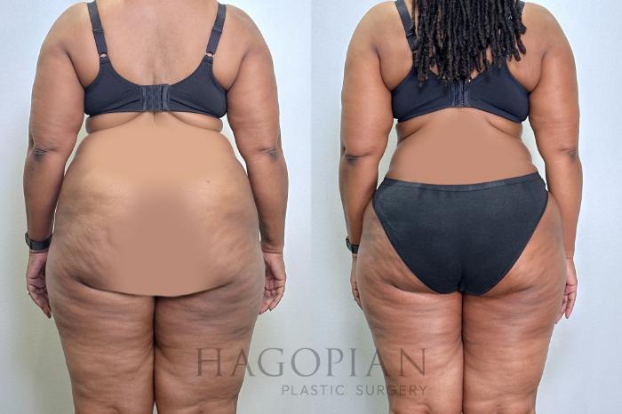 Before & After Drainless Tummy Tuck Case 131 Back View in Atlanta, GA