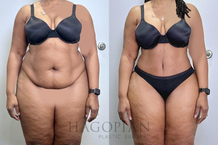 Before & After Drainless Tummy Tuck Case 131 Front View in Atlanta, GA