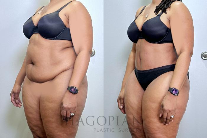 Before & After Drainless Tummy Tuck Case 131 Left Oblique View in Atlanta, GA