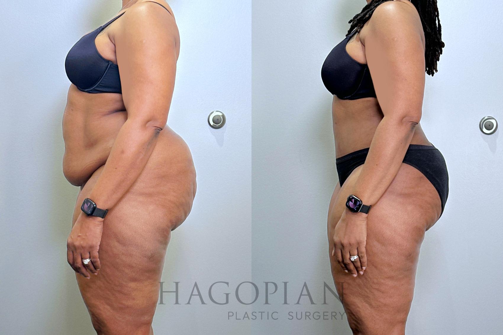 Before & After Drainless Tummy Tuck Case 131 Left Side View in Atlanta, GA