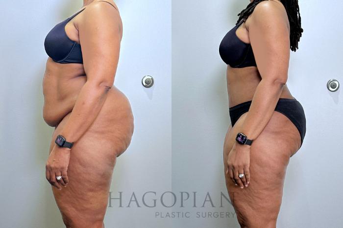 Before & After Drainless Tummy Tuck Case 131 Left Side View in Atlanta, GA