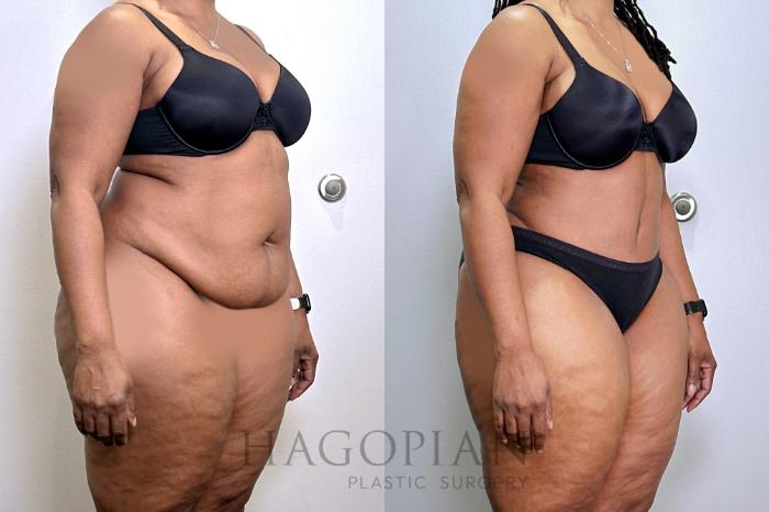 Before & After Drainless Tummy Tuck Case 131 Right Oblique View in Atlanta, GA