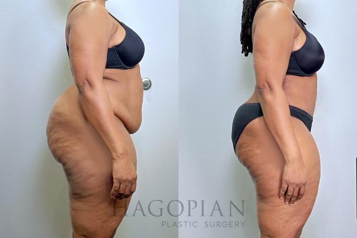 Before & After Drainless Tummy Tuck Case 131 Right Side View in Atlanta, GA