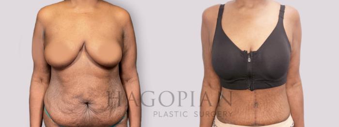 Before & After Drainless Tummy Tuck Case 136 Front View in Atlanta, GA