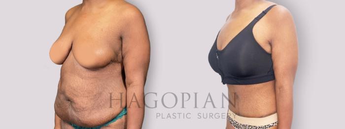 Before & After Drainless Tummy Tuck Case 136 Left Oblique View in Atlanta, GA