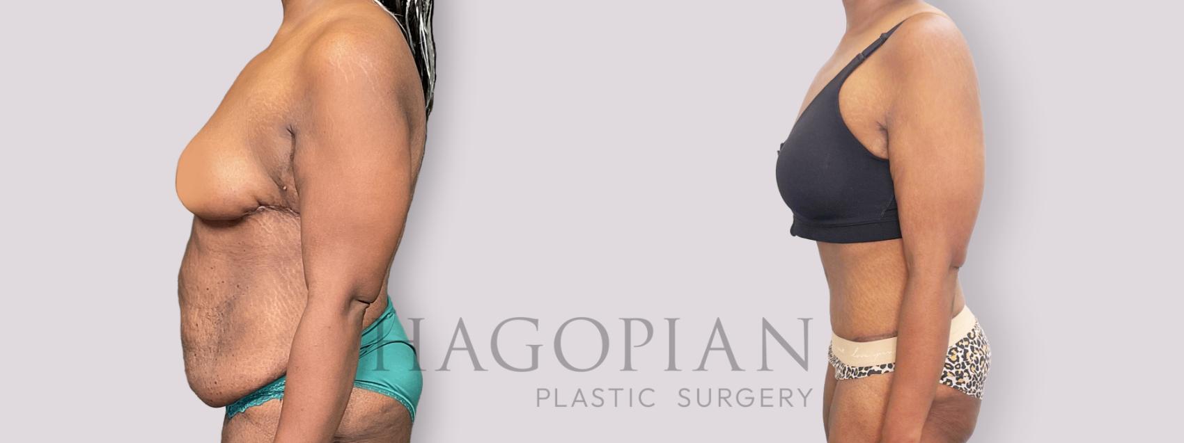 Before & After Drainless Tummy Tuck Case 136 Left Side View in Atlanta, GA