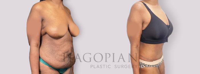 Before & After Drainless Tummy Tuck Case 136 Right Oblique View in Atlanta, GA