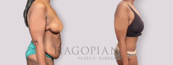 Before & After Drainless Tummy Tuck Case 136 Right Side View in Atlanta, GA