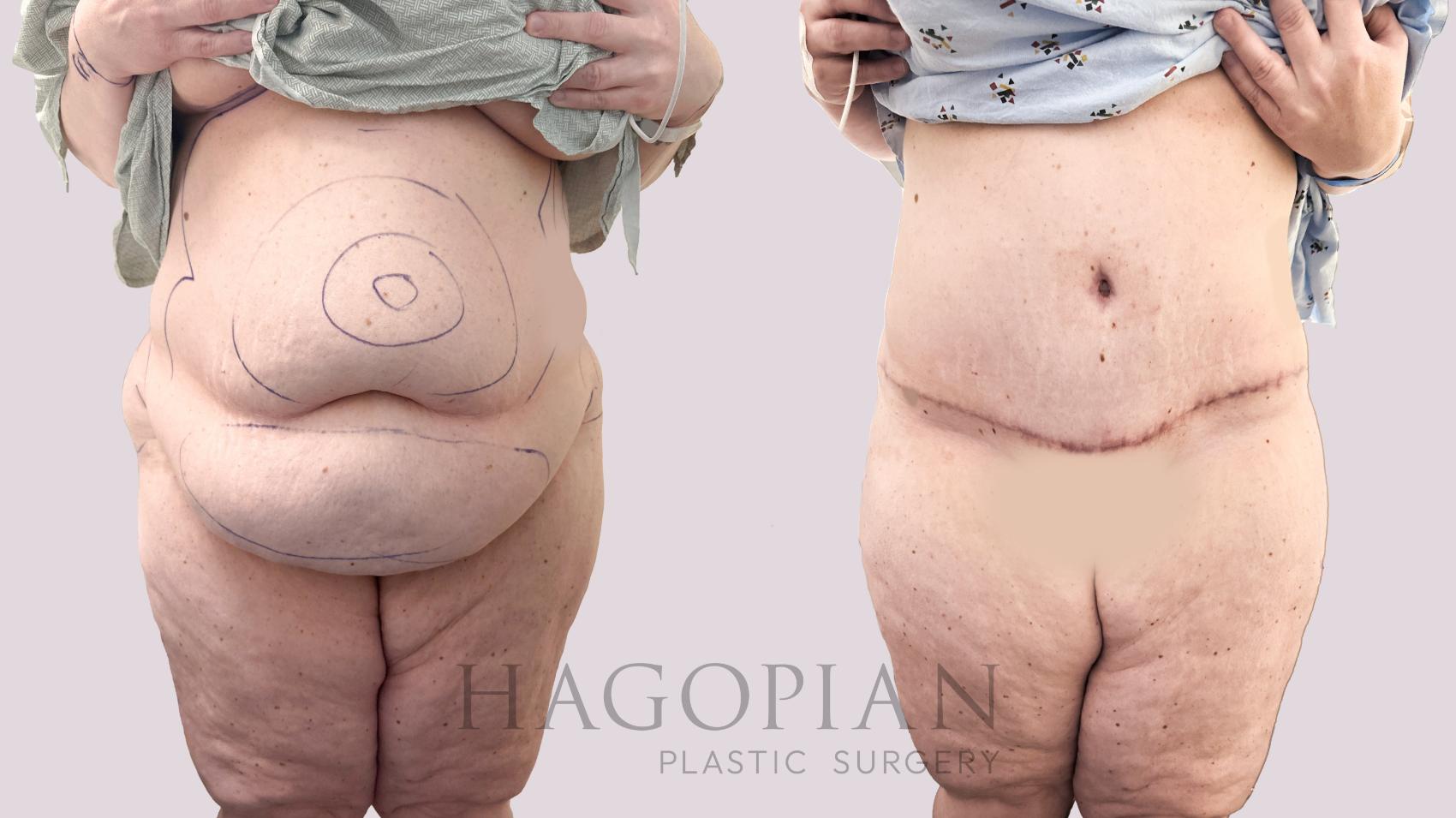 Before & After Lipedema Surgery Case 173 Front View in Atlanta, GA