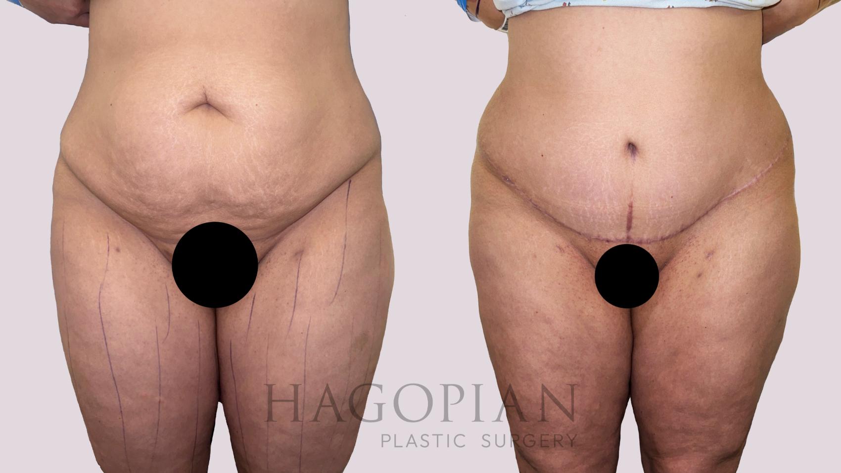 Before & After Drainless Tummy Tuck Case 181 Front View in Atlanta, GA