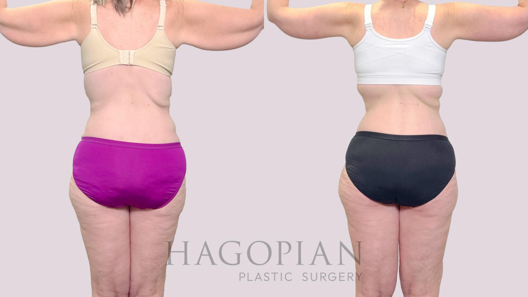 Before & After Drainless Tummy Tuck Case 189 Back View in Atlanta, GA