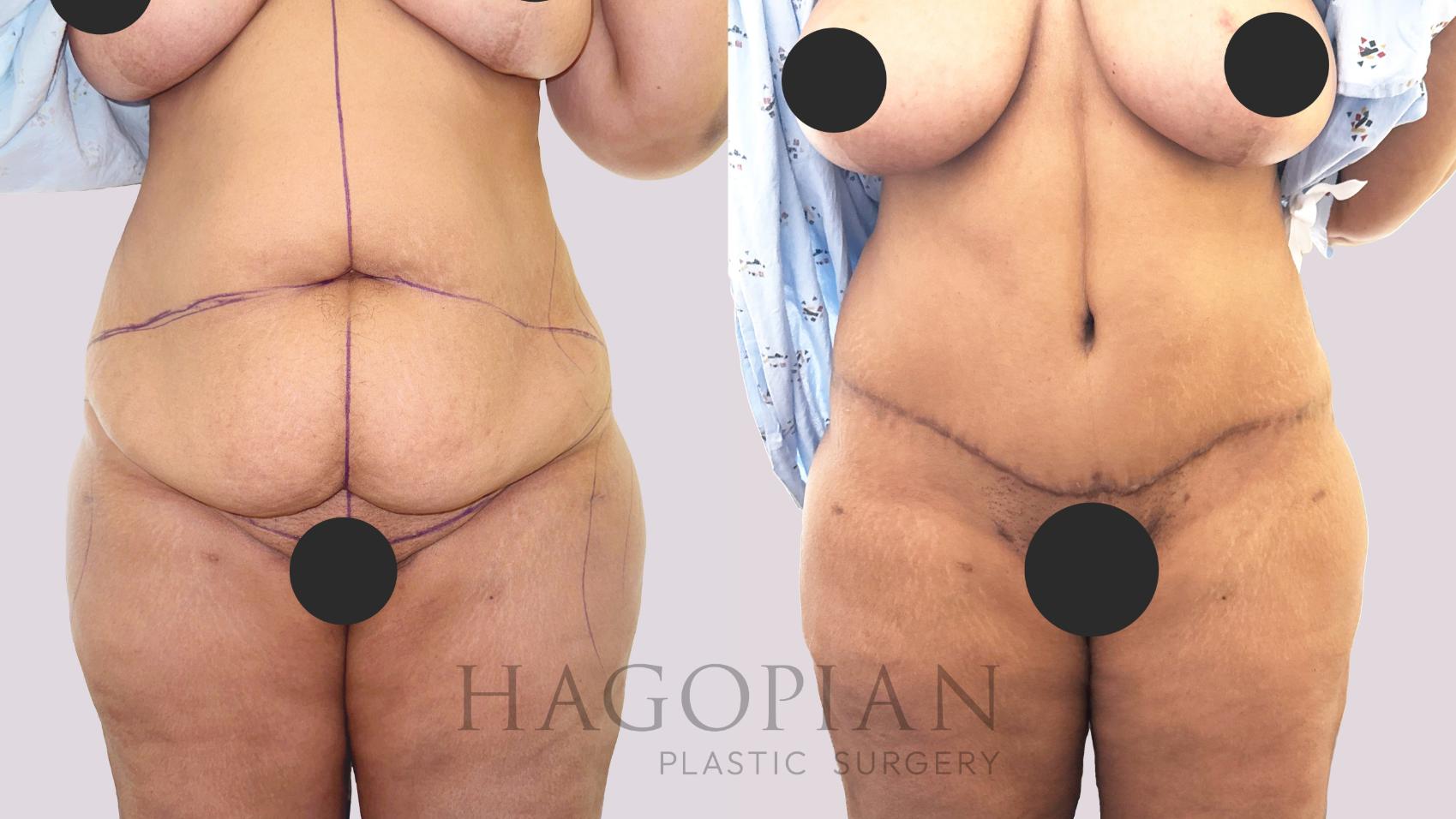 Before & After Drainless Tummy Tuck Case 192 Front View in Atlanta, GA