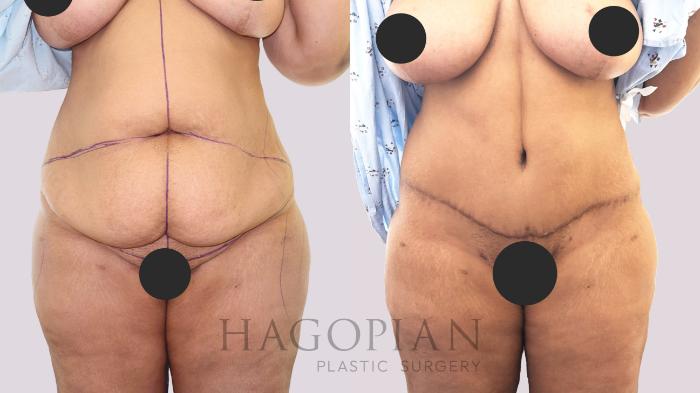 Before & After Drainless Tummy Tuck Case 192 Front View in Atlanta, GA