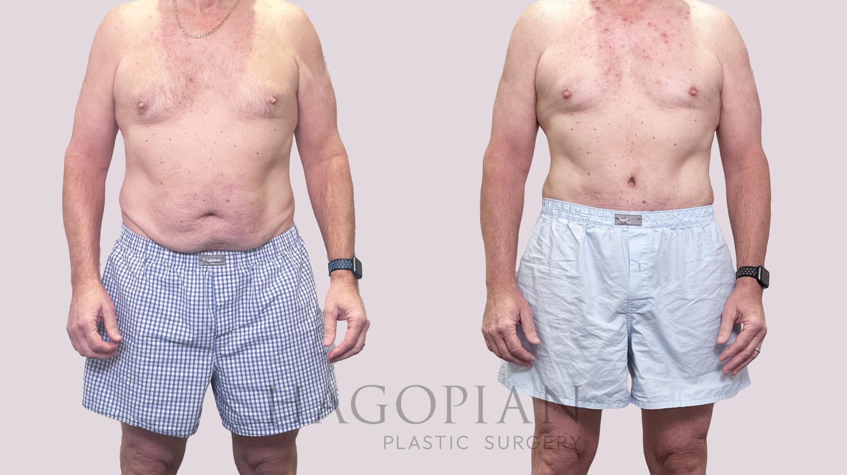 Before & After Drainless Tummy Tuck Case 195 Front View in Atlanta, GA