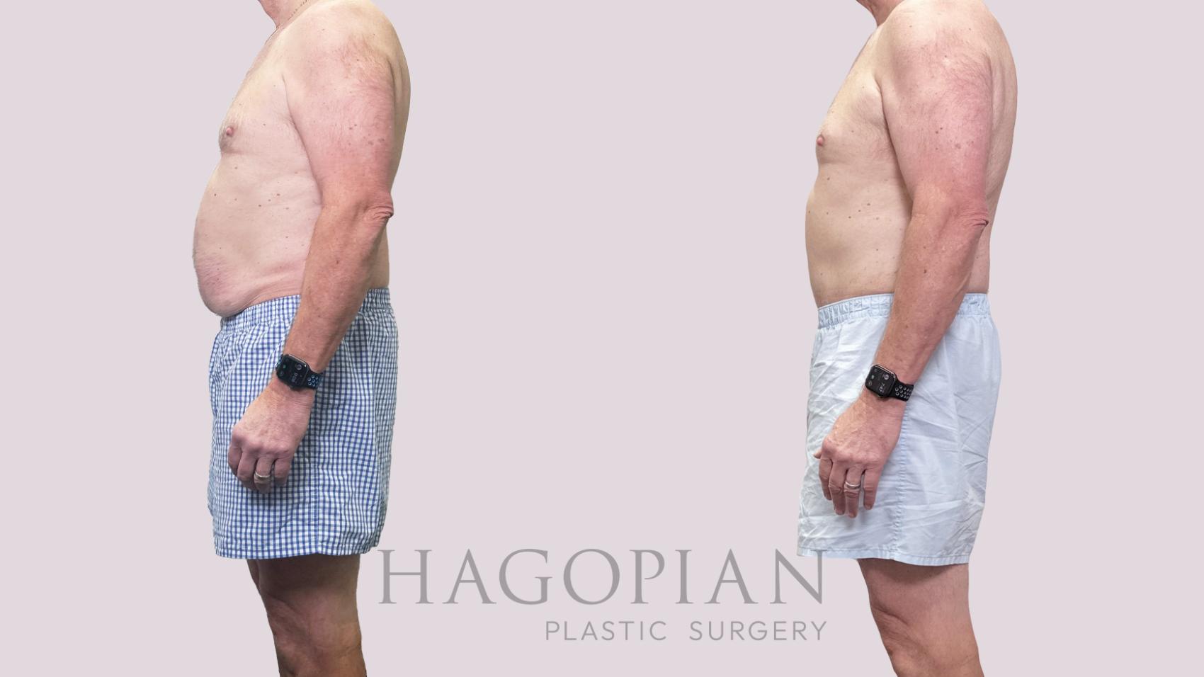 Before & After Drainless Tummy Tuck Case 195 Left Side View in Atlanta, GA