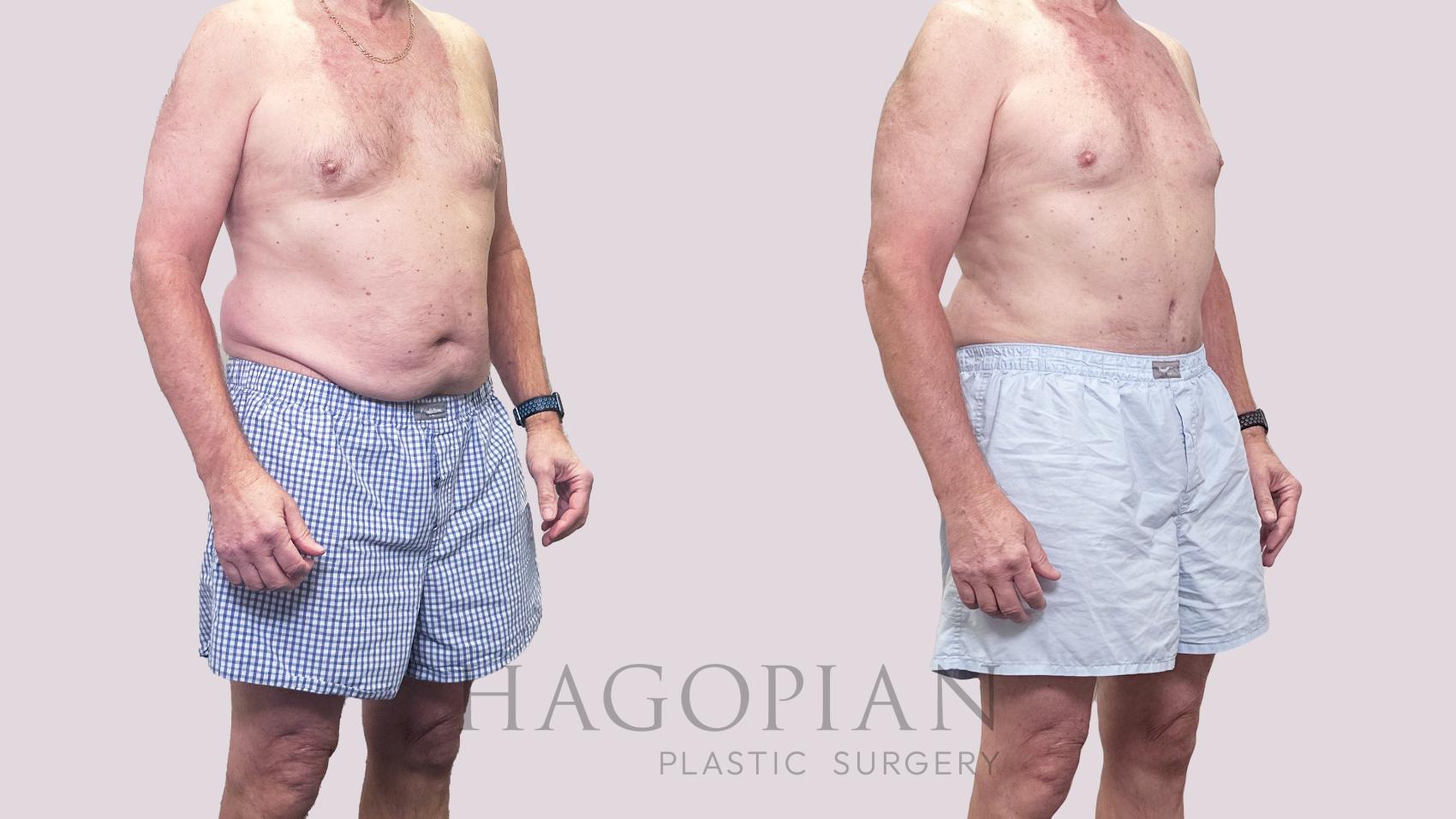 Before & After Drainless Tummy Tuck Case 195 Right Oblique View in Atlanta, GA