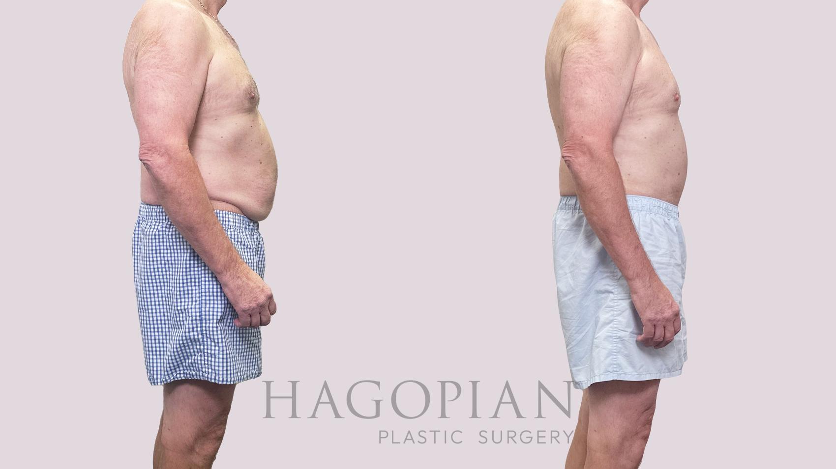 Before & After Drainless Tummy Tuck Case 195 Right Side View in Atlanta, GA
