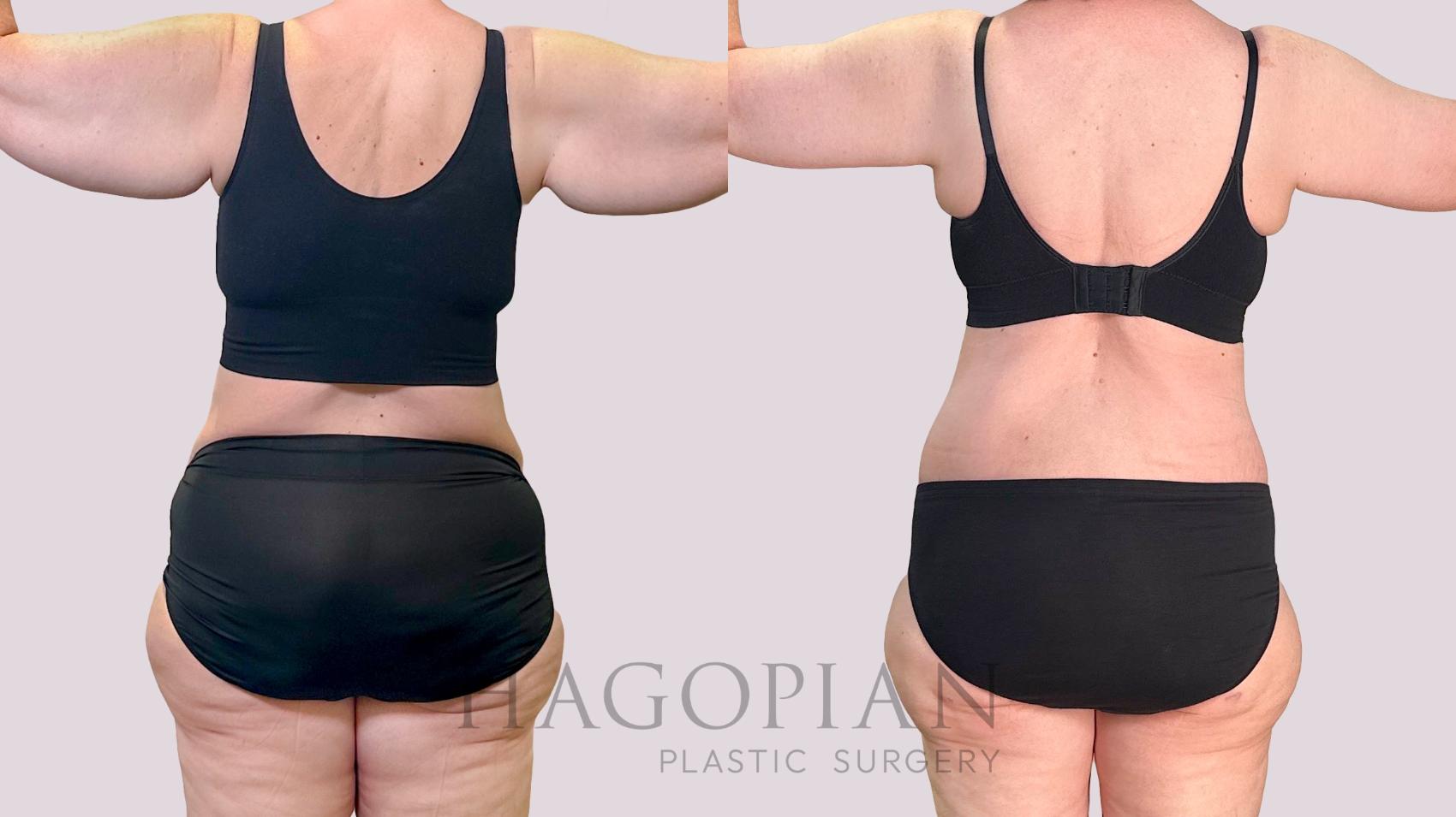 Before & After Drainless Tummy Tuck Case 198 Back View in Atlanta, GA