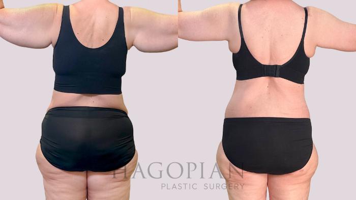 Before & After Drainless Tummy Tuck Case 198 Back View in Atlanta, GA