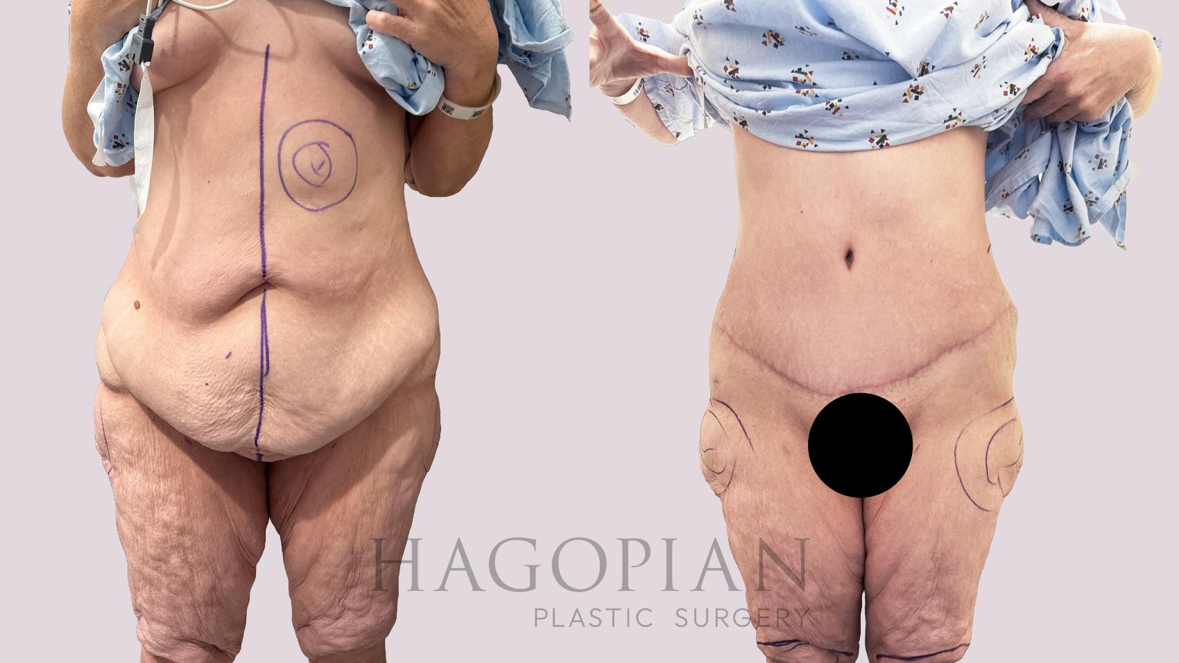 Before & After Drainless Tummy Tuck Case 198 Front View in Atlanta, GA