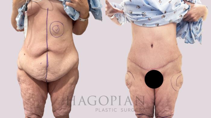 Before & After Drainless Tummy Tuck Case 198 Front View in Atlanta, GA