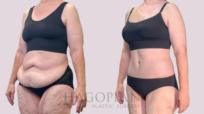 Before & After Drainless Tummy Tuck Case 198 Left Oblique View in Atlanta, GA