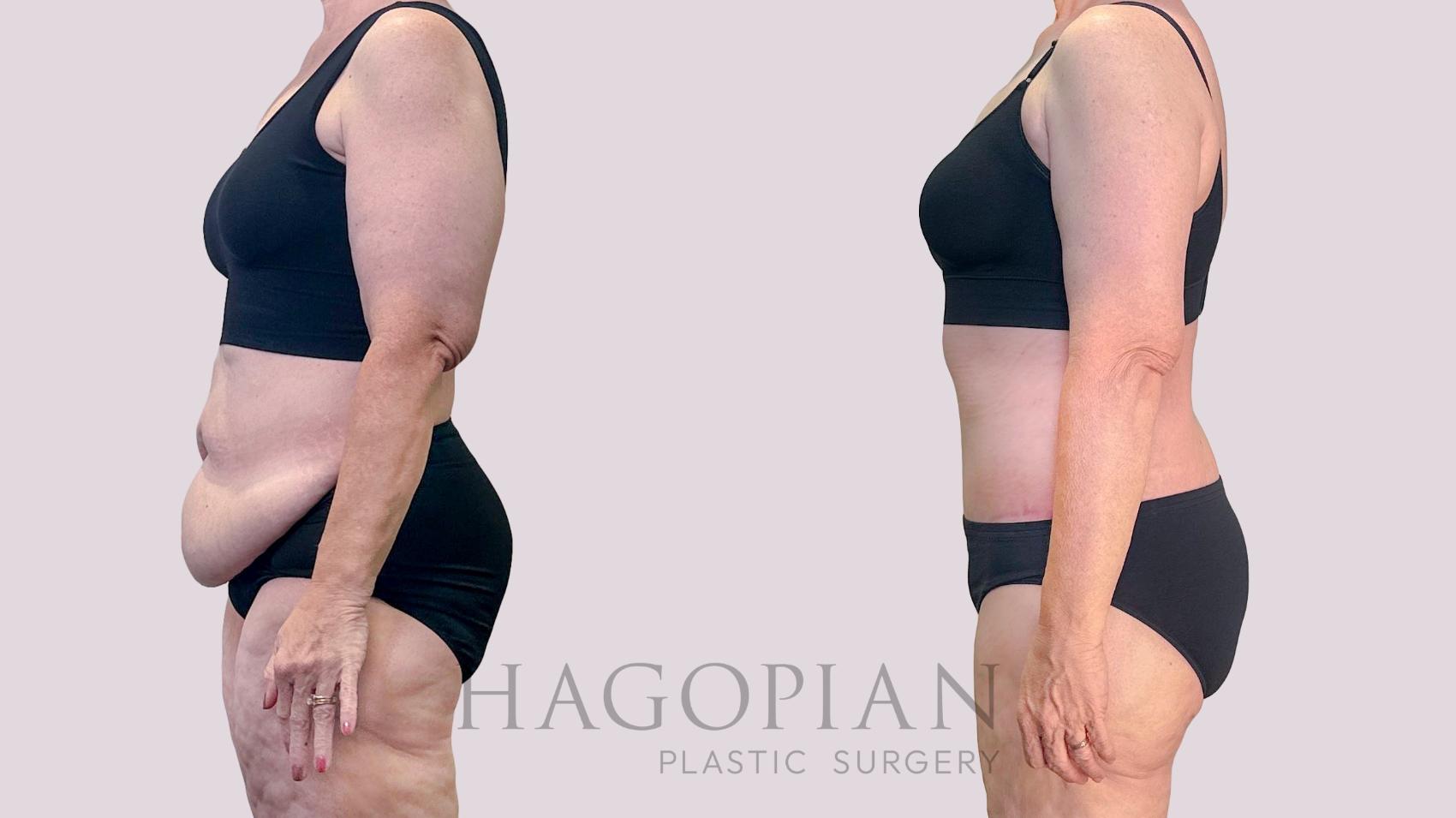 Before & After Drainless Tummy Tuck Case 198 Left Side View in Atlanta, GA
