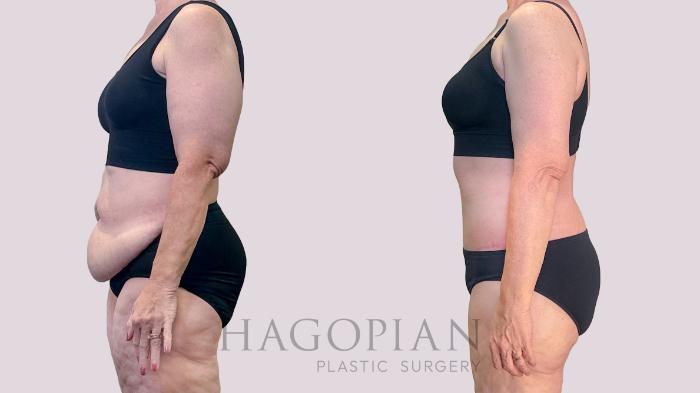 Before & After Drainless Tummy Tuck Case 198 Left Side View in Atlanta, GA