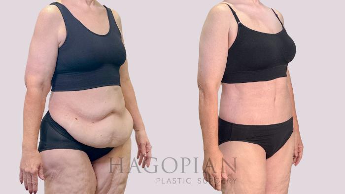 Before & After Drainless Tummy Tuck Case 198 Right Oblique View in Atlanta, GA