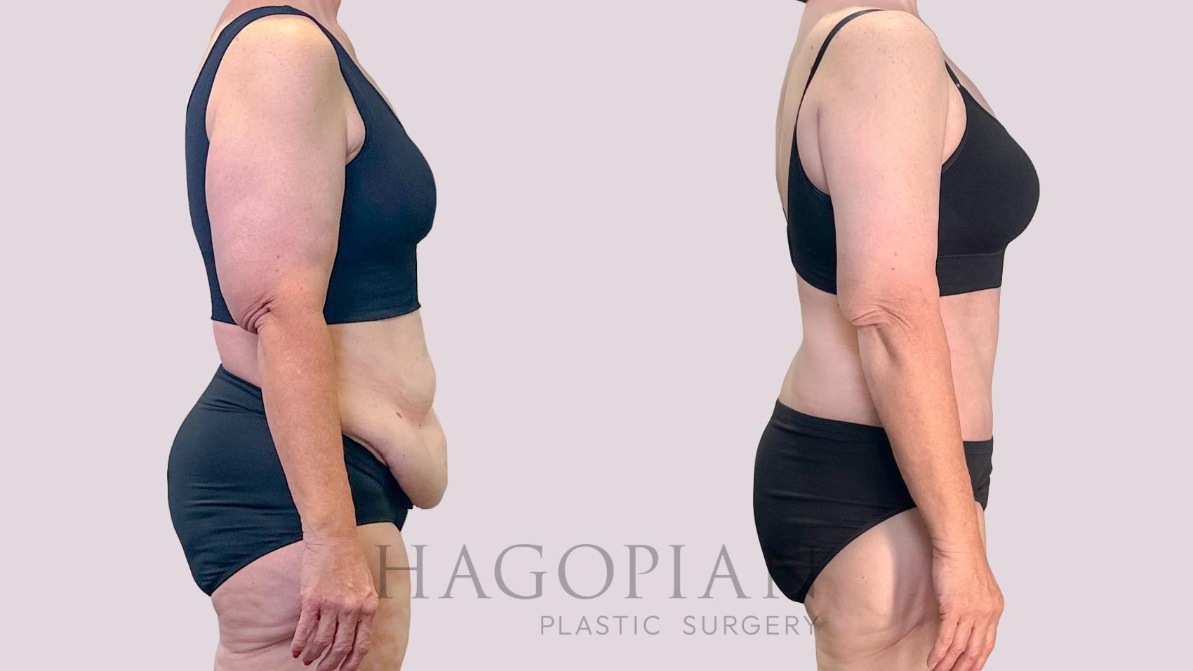 Before & After Drainless Tummy Tuck Case 198 Right Side View in Atlanta, GA