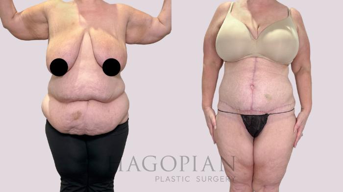 Before & After Drainless Tummy Tuck Case 215 Front View in Atlanta, GA
