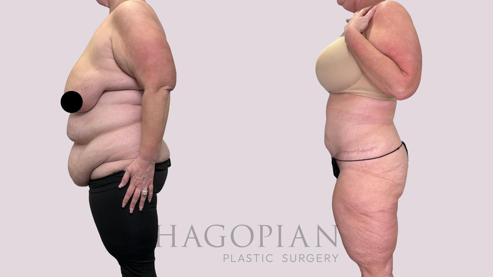 Before & After Drainless Tummy Tuck Case 215 Left Side View in Atlanta, GA